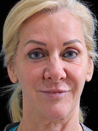 Karen Sticka, PA Case 2 - Before