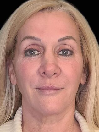 Karen Sticka, PA Case 2 - After