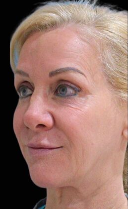 Karen Sticka, PA: Case 2 - Before