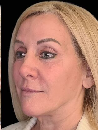 Karen Sticka, PA: Case 2 - After