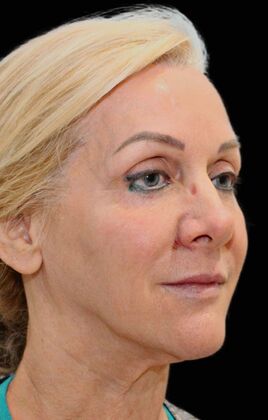 Karen Sticka, PA: Case 2 - Before