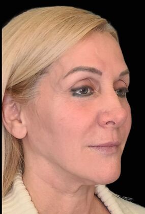 Karen Sticka, PA: Case 2 - After