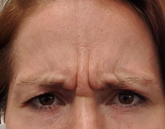 Karen Sticka, PA Case 4 - Before