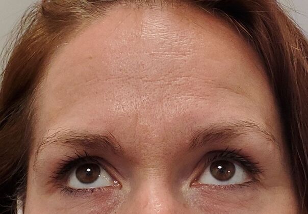 Karen Sticka, PA: Case 4 - After