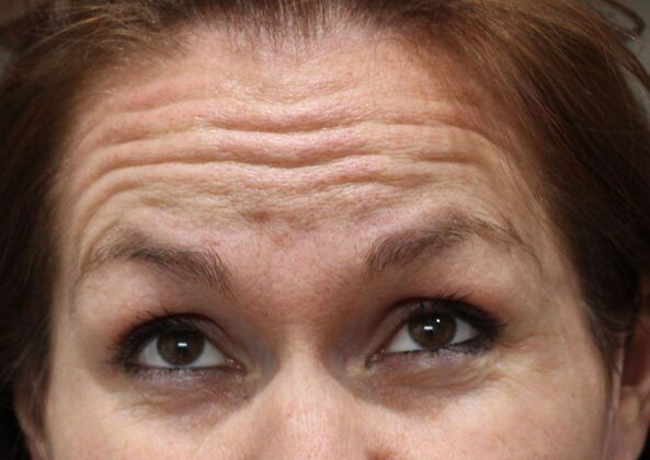 Karen Sticka, PA: Case 4 - Before