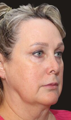 Karen Sticka, PA Case 5 - Before