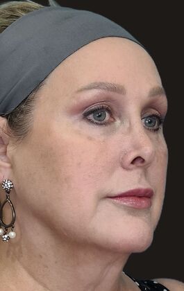 Karen Sticka, PA Case 5 - After