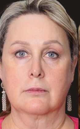 Karen Sticka, PA: Case 5 - Before