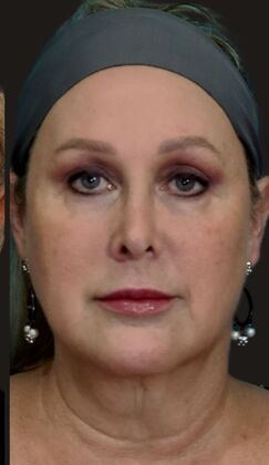 Karen Sticka, PA: Case 5 - After