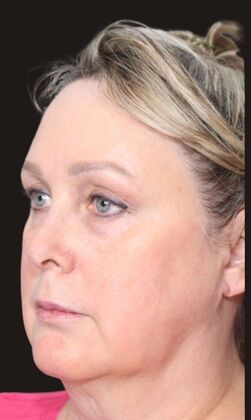 Karen Sticka, PA: Case 5 - Before