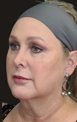 Karen Sticka, PA: Case 5 - After