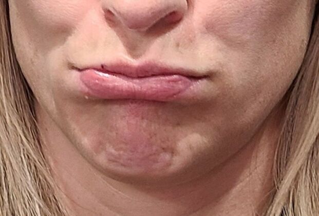 Karen Sticka, PA: Case 6 - Before