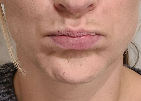 Karen Sticka, PA: Case 6 - After