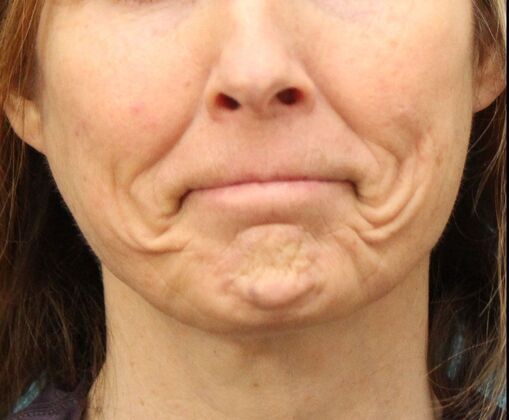 Karen Sticka, PA: Case 1 - Before