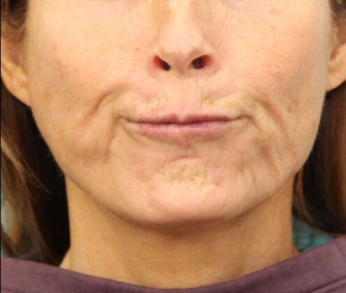 Karen Sticka, PA: Case 1 - After