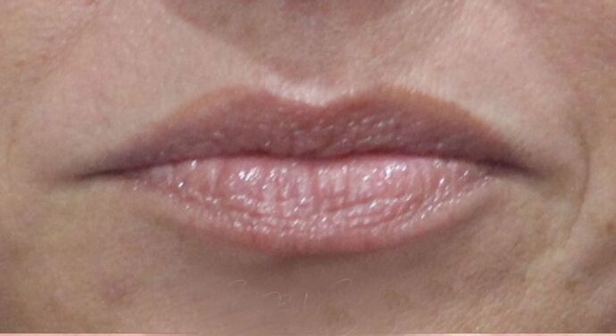 Karen Sticka, PA Case 8 - Before