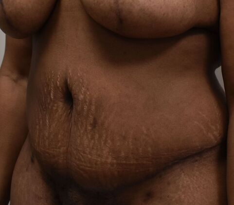 Tummy Tuck (Abdominoplasty): Case 388 - After