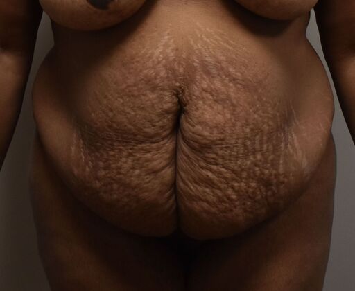 Tummy Tuck (Abdominoplasty): Case 388 - Before