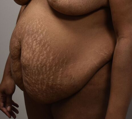 Tummy Tuck (Abdominoplasty): Case 388 - Before