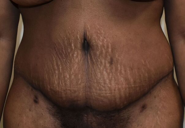 Massive Weight Loss : Case 114 - After