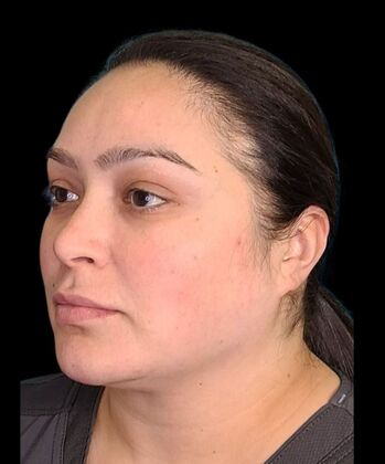 Karen Sticka, PA: Case 9 - After