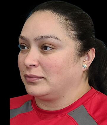 Karen Sticka, PA: Case 9 - Before