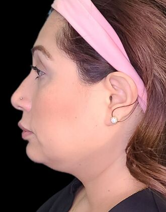 Karen Sticka, PA: Case 10 - Before