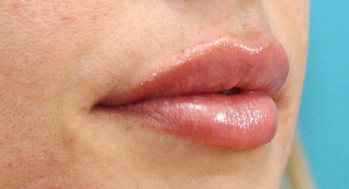 Karen Sticka, PA Case 11 - After