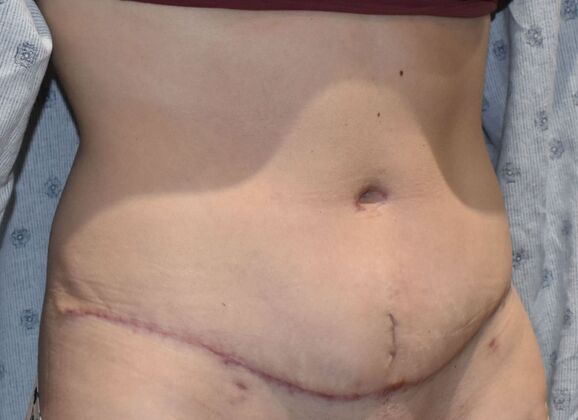 Tummy Tuck (Abdominoplasty): Case 377 - After