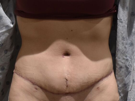 Tummy Tuck (Abdominoplasty): Case 377 - After