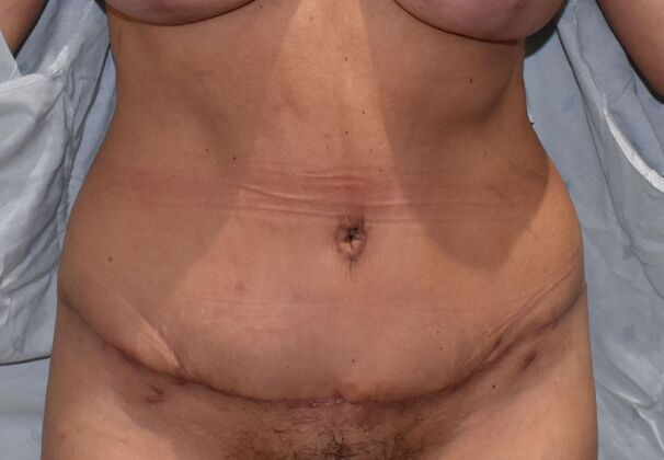 Tummy Tuck (Abdominoplasty): Case 389 - After