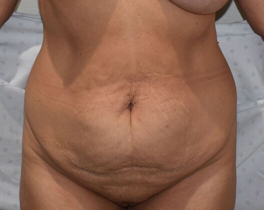 Tummy Tuck (Abdominoplasty): Case 389 - Before