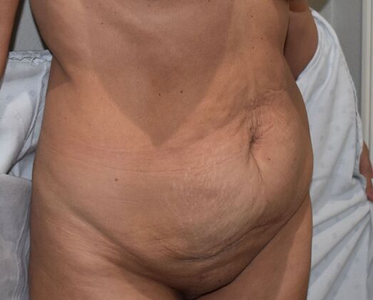 Tummy Tuck (Abdominoplasty): Case 389 - Before