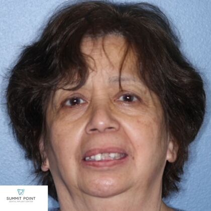 All on 4 Dental Implants Case 5 - Before