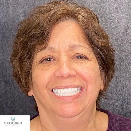 All on 4 Dental Implants Case 5 - After