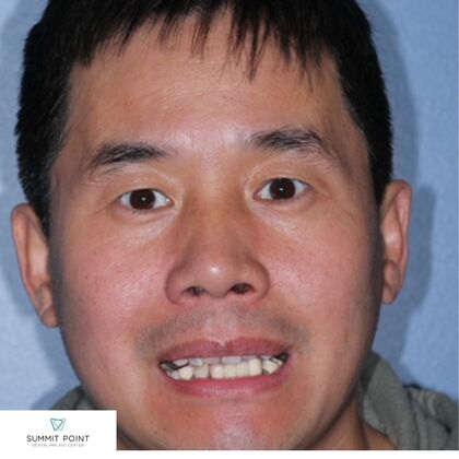 All on 4 Dental Implants Case 6 - Before