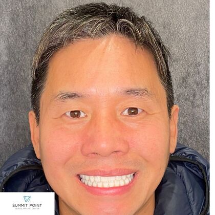 All on 4 Dental Implants Case 6 - After