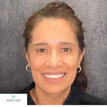 All on 4 Dental Implants Case 8 - After