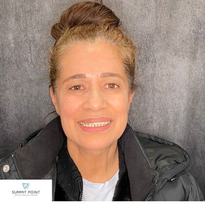 All on 4 Dental Implants Case 8 - Before