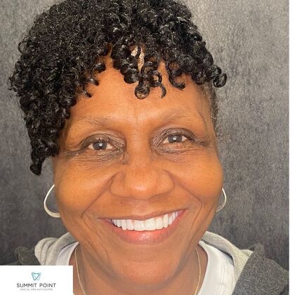 All on 4 Dental Implants Case 10 - After