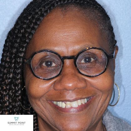 All on 4 Dental Implants Case 10 - Before