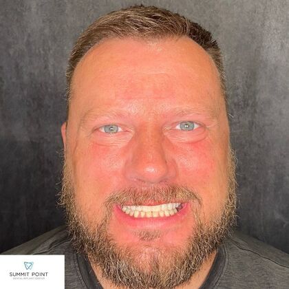 All on 4 Dental Implants Case 11 - After