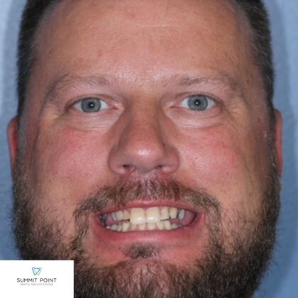 All on 4 Dental Implants Case 11 - Before