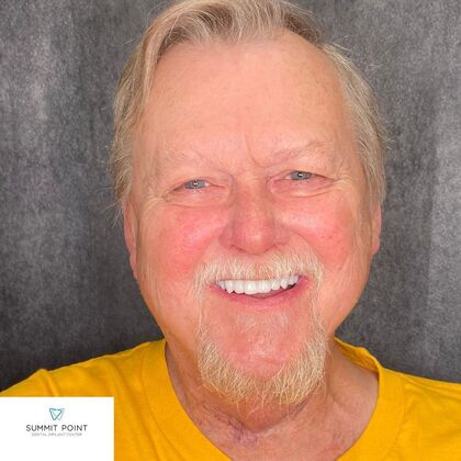 All on 4 Dental Implants Case 12 - After