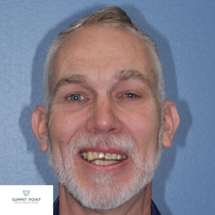 All on 4 Dental Implants: Case 13 - Before