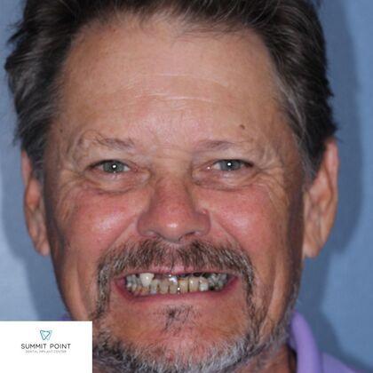 All on 4 Dental Implants Case 14 - Before