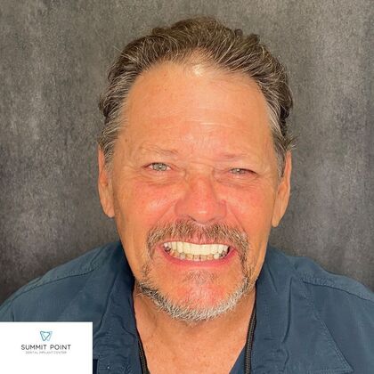 All on 4 Dental Implants Case 14 - After