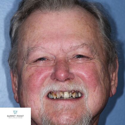 All on 4 Dental Implants Case 12 - Before