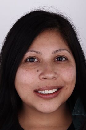 Porcelain Veneers: Marisol- porcelain veneers - After