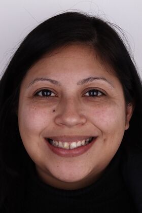 Porcelain Veneers: Marisol- porcelain veneers - Before